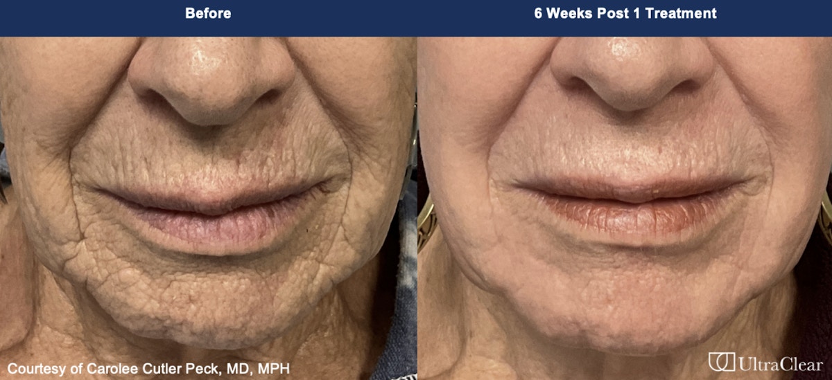 UltraClear® Laser Before & After Gallery - Patient 407090 - Image 1