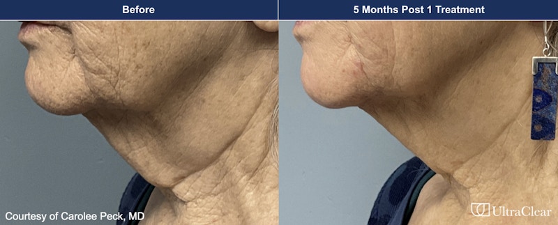 UltraClear® Laser Before & After Gallery - Patient 207736 - Image 1