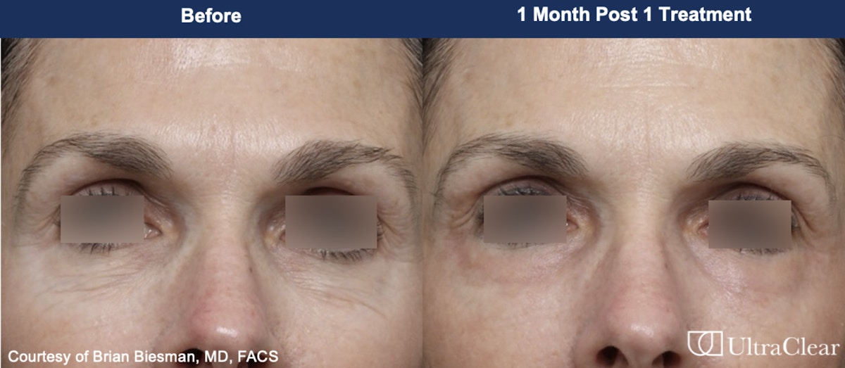 UltraClear® Laser Before & After Gallery - Patient 773200 - Image 1