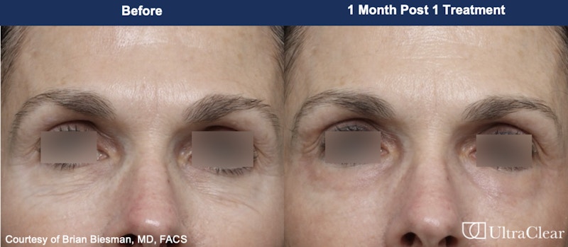 UltraClear® Laser Before & After Gallery - Patient 773200 - Image 1
