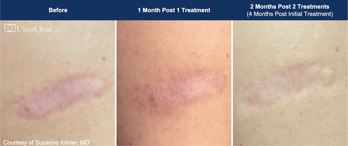 UltraClear® Laser Before & After Gallery - Patient 244174 - Image 1