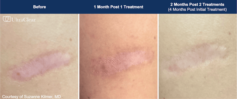 UltraClear® Laser Before & After Gallery - Patient 244174 - Image 1