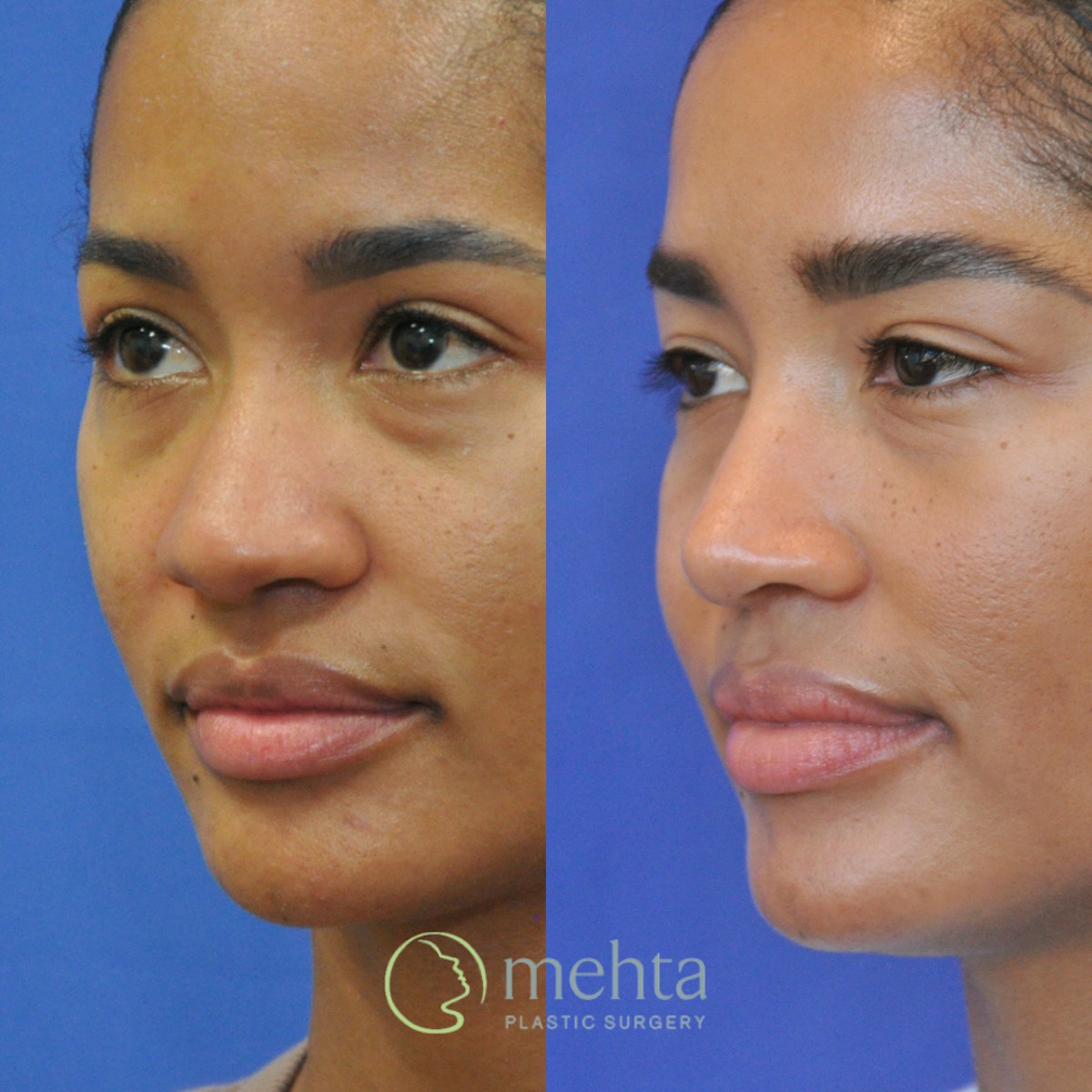 Rhinoplasty Before & After Gallery - Patient 127644 - Image 2