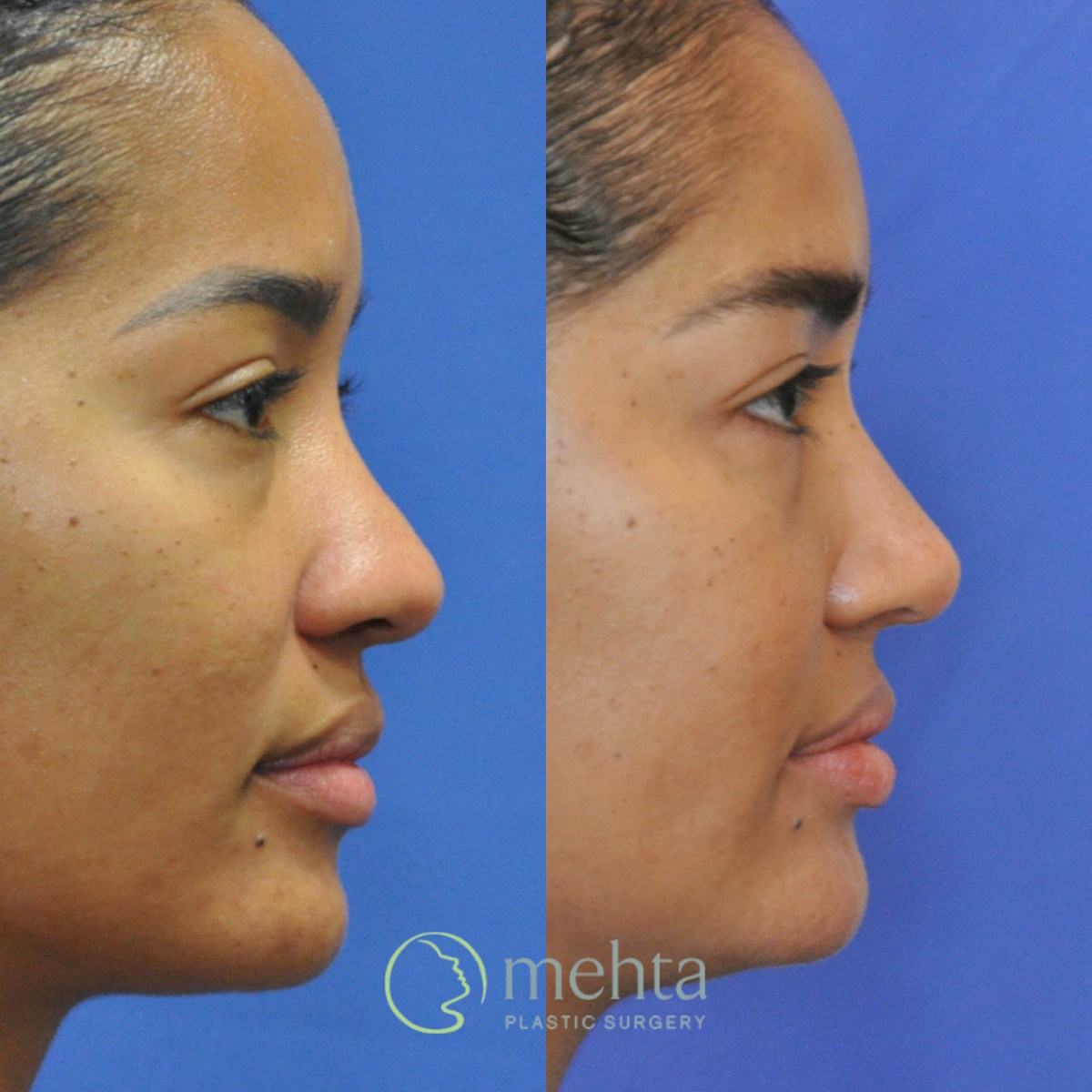 Rhinoplasty Before & After Gallery - Patient 127644 - Image 5
