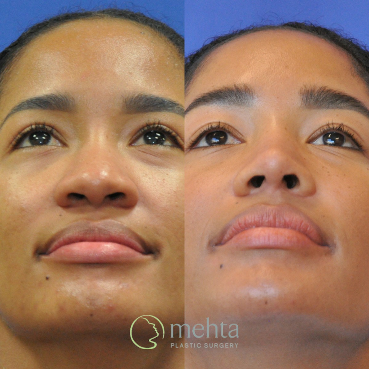 Rhinoplasty Before & After Gallery - Patient 127644 - Image 6