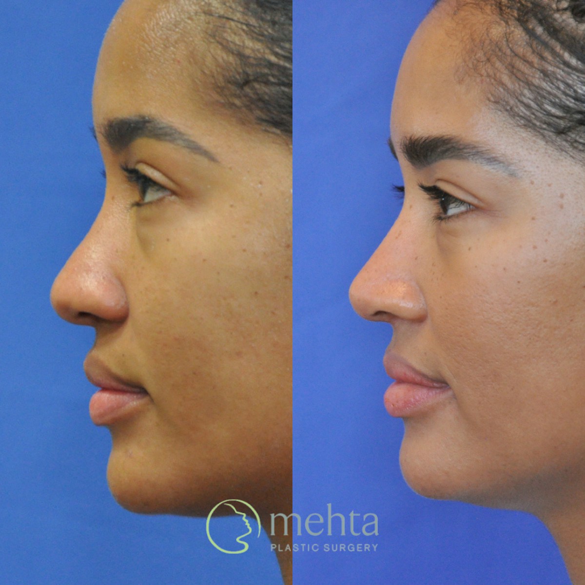 Rhinoplasty Before & After Gallery - Patient 127644 - Image 1