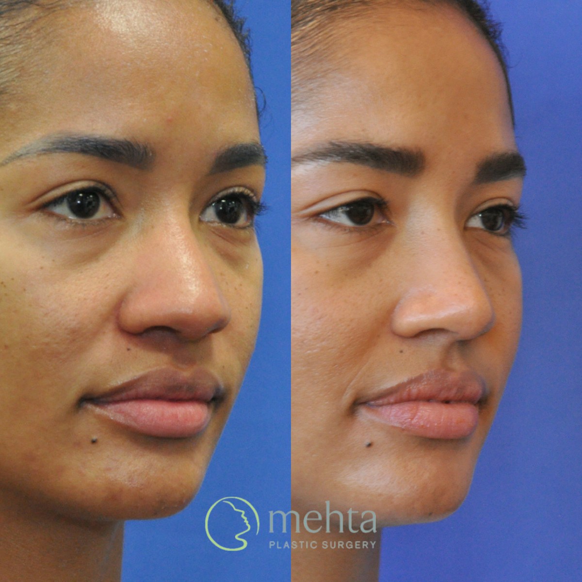 Rhinoplasty Before & After Gallery - Patient 127644 - Image 4
