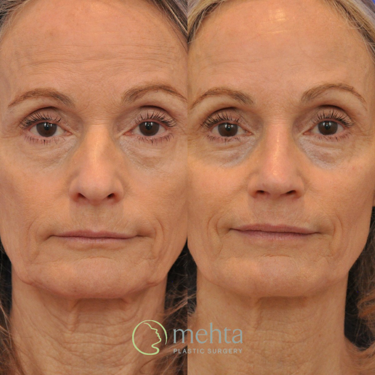 Rhinoplasty Before & After Gallery - Patient 291130 - Image 3