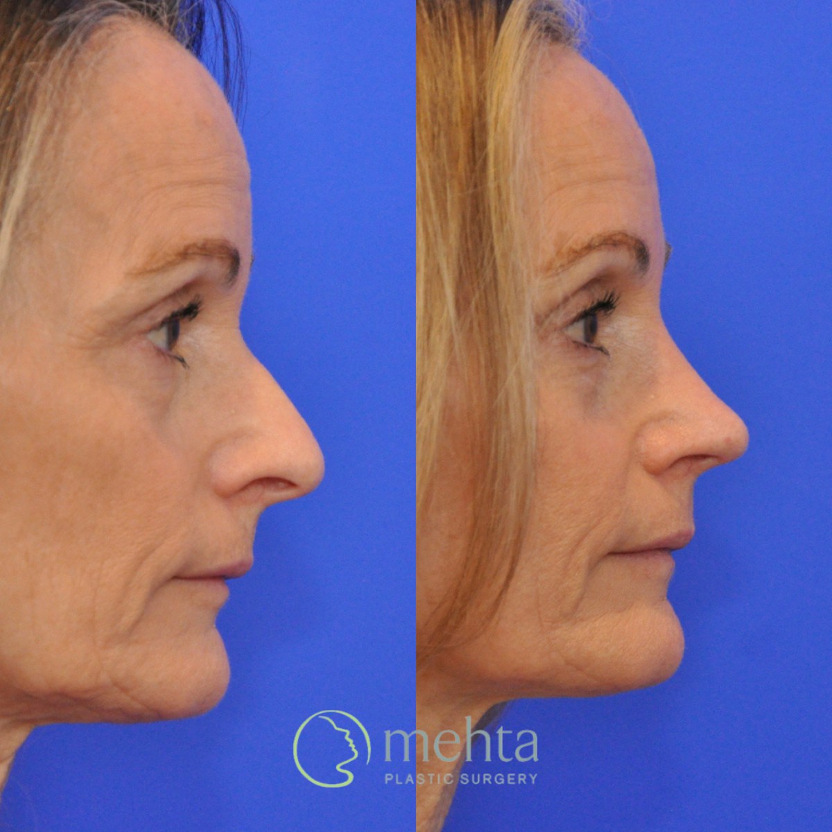 Rhinoplasty Before & After Gallery - Patient 291130 - Image 6