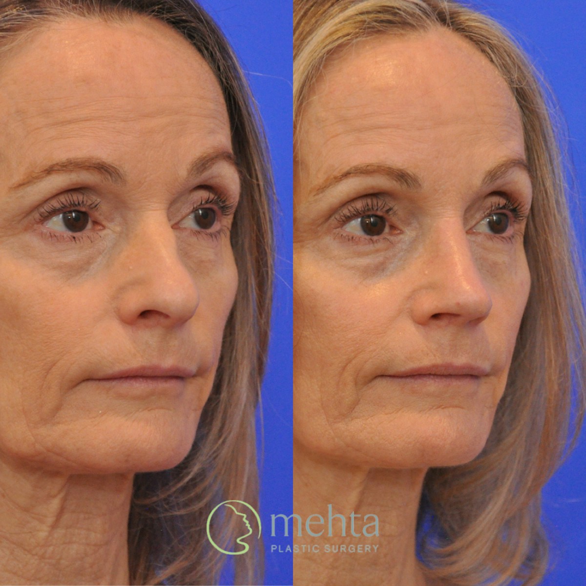 Rhinoplasty Before & After Gallery - Patient 291130 - Image 4