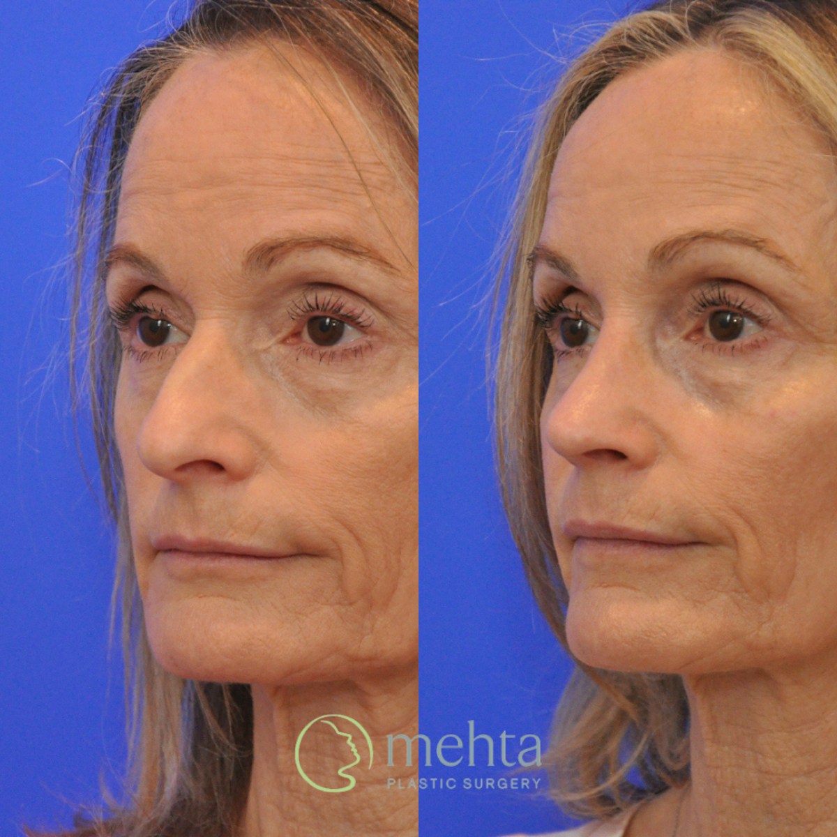 Rhinoplasty Before & After Gallery - Patient 291130 - Image 2