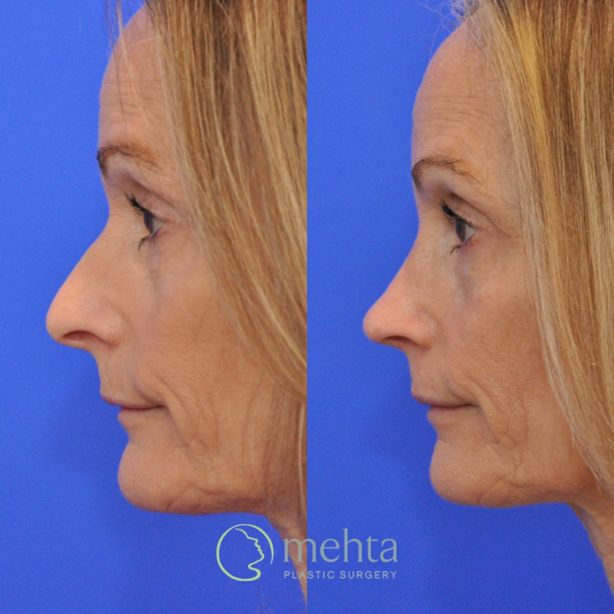 Rhinoplasty Before & After Gallery - Patient 291130 - Image 1