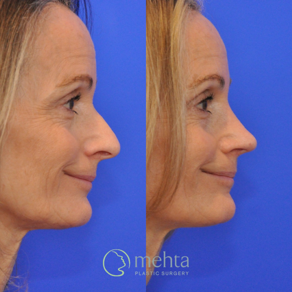Rhinoplasty Before & After Gallery - Patient 291130 - Image 5