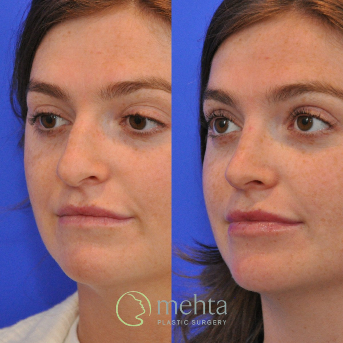 Rhinoplasty Before & After Gallery - Patient 351592 - Image 2