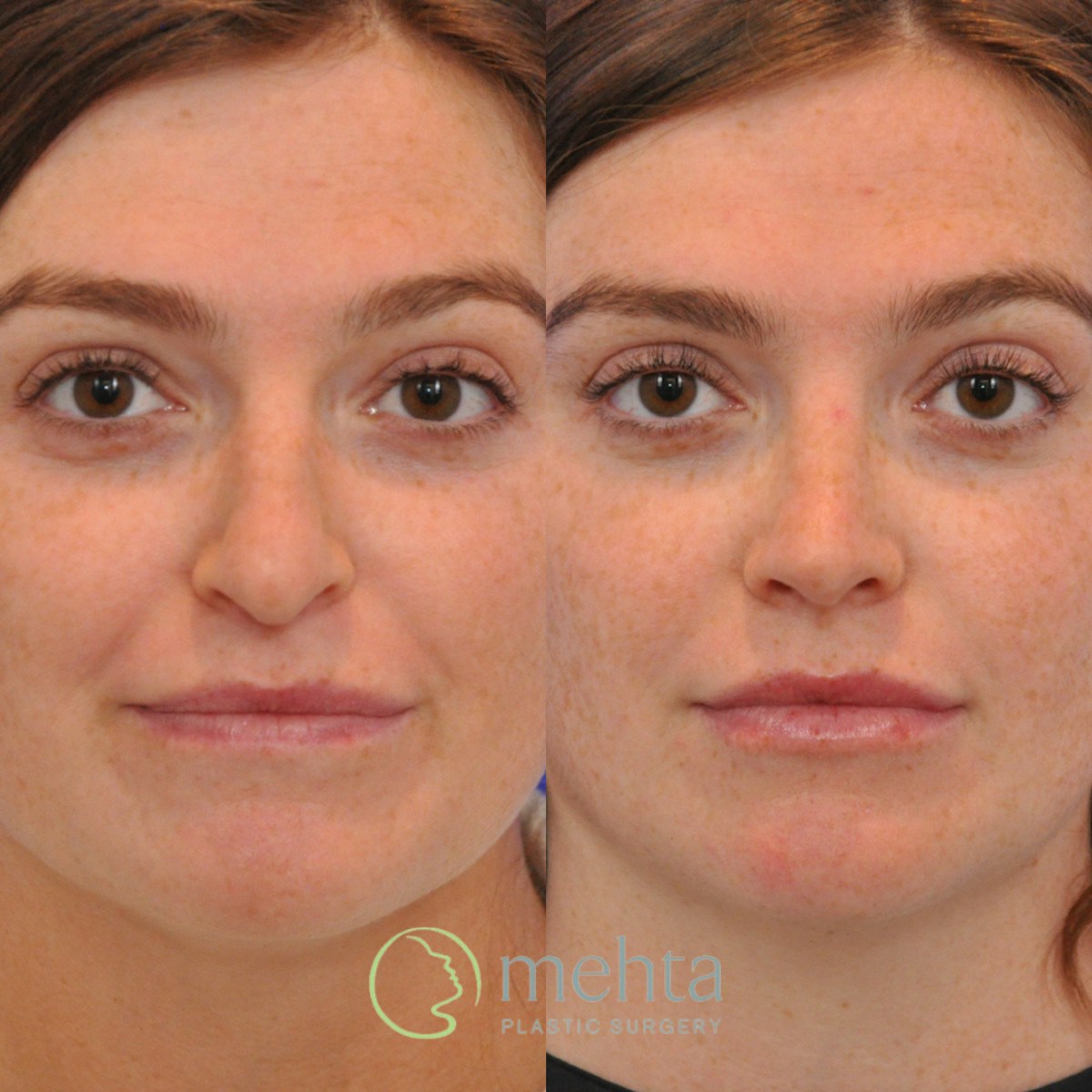 Rhinoplasty Before & After Gallery - Patient 351592 - Image 3