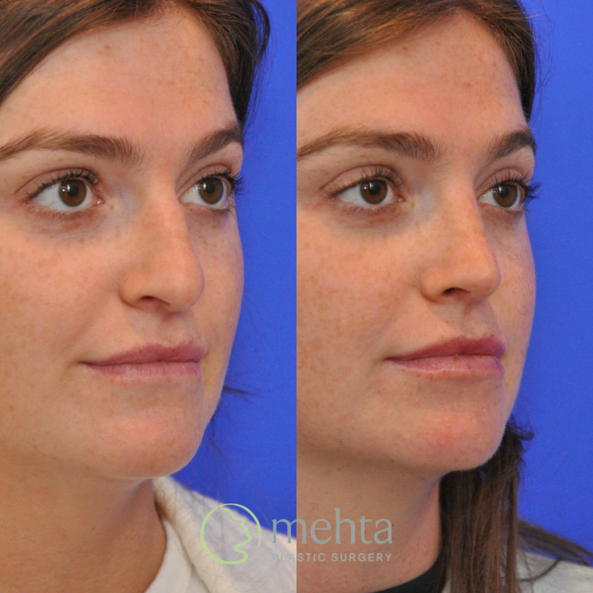 Rhinoplasty Before & After Gallery - Patient 351592 - Image 4