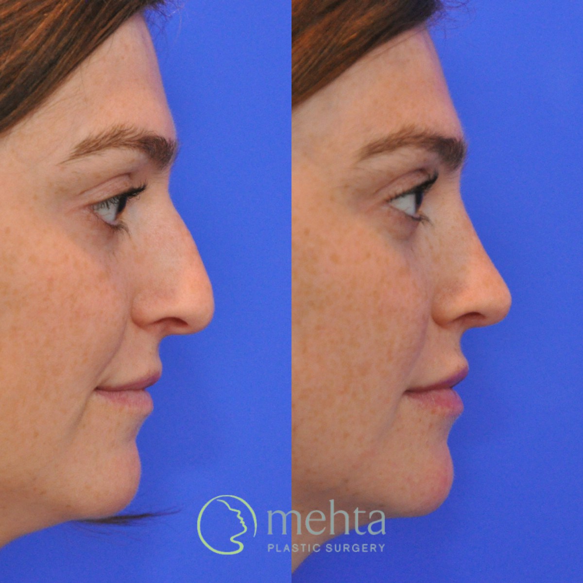 Rhinoplasty Before & After Gallery - Patient 351592 - Image 5