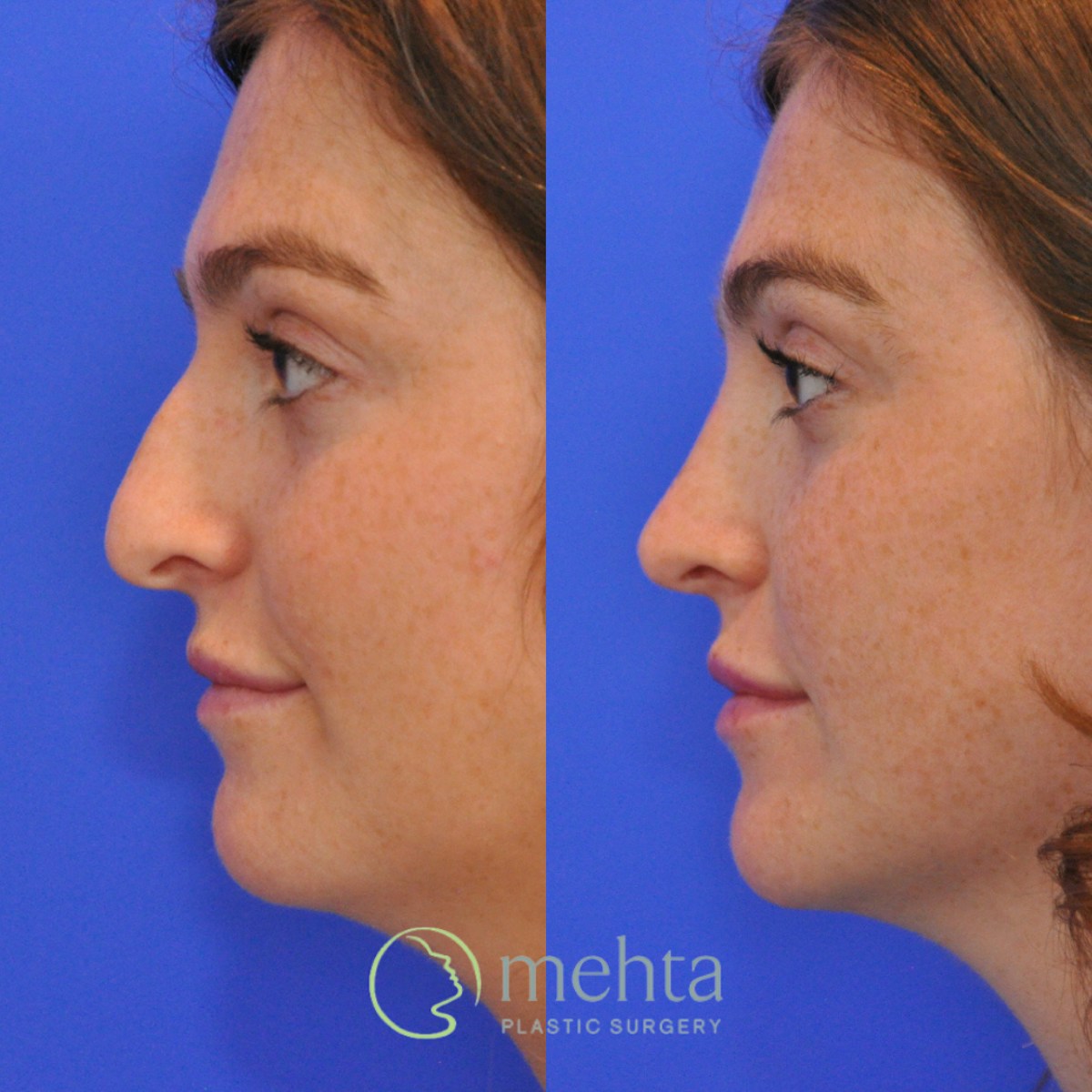 Rhinoplasty Before & After Gallery - Patient 351592 - Image 1