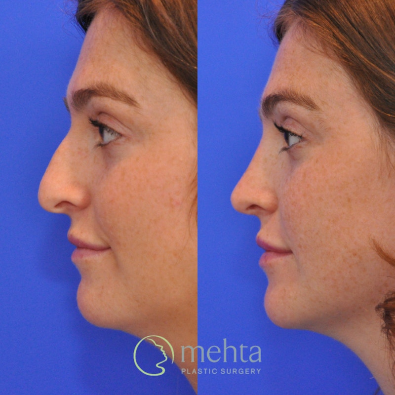 Rhinoplasty Before & After Gallery - Patient 351592 - Image 1