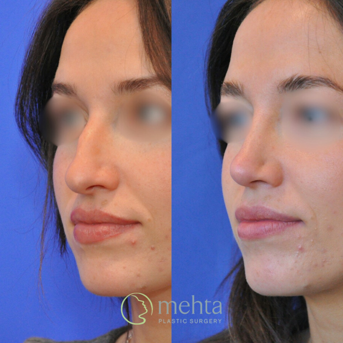 Rhinoplasty Before & After Gallery - Patient 423108 - Image 2
