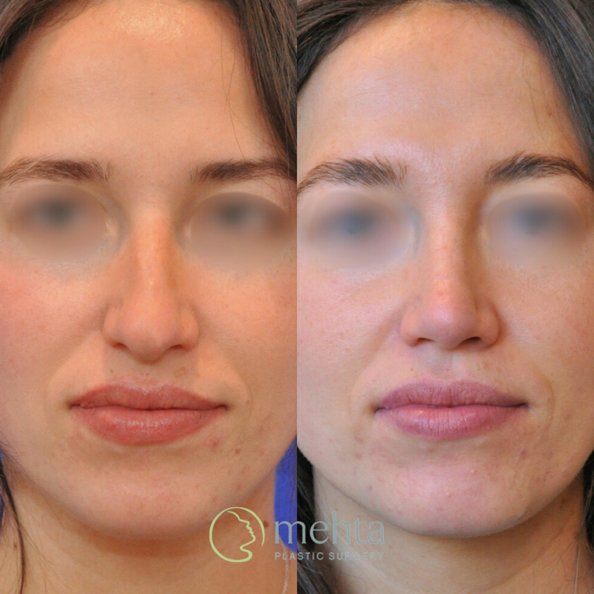 Rhinoplasty Before & After Gallery - Patient 423108 - Image 3