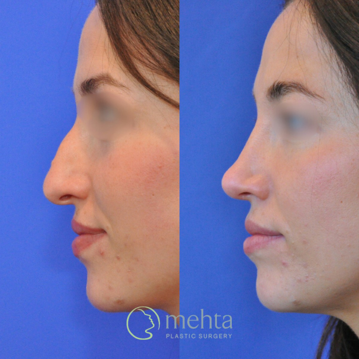 Rhinoplasty Before & After Gallery - Patient 423108 - Image 1