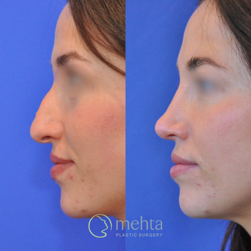 Rhinoplasty Before & After Gallery - Patient 423108 - Image 1