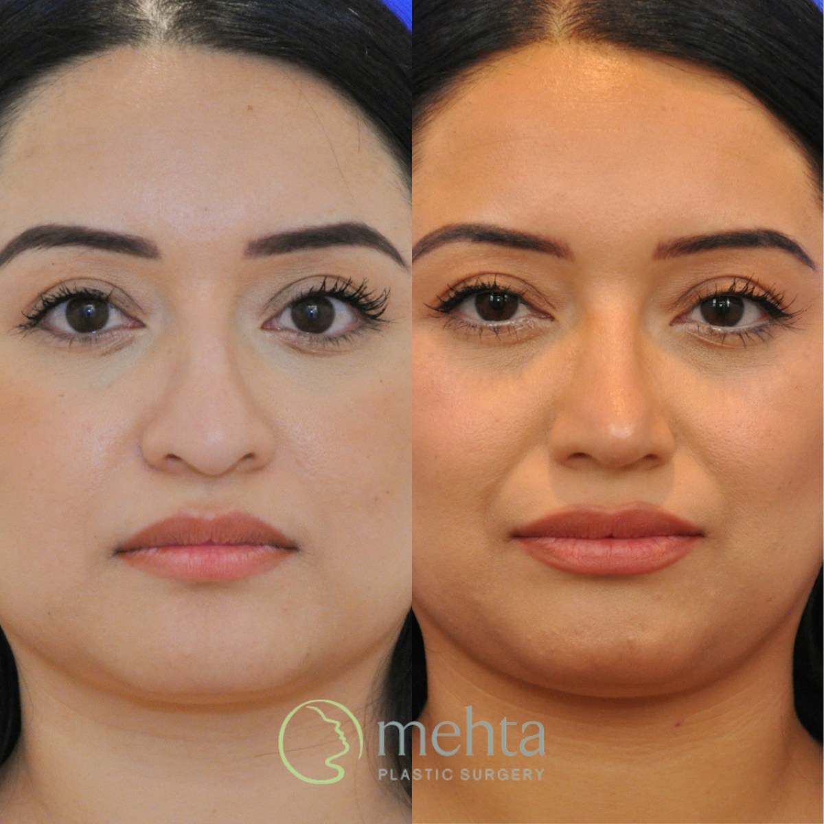 Rhinoplasty Before & After Gallery - Patient 697849 - Image 3