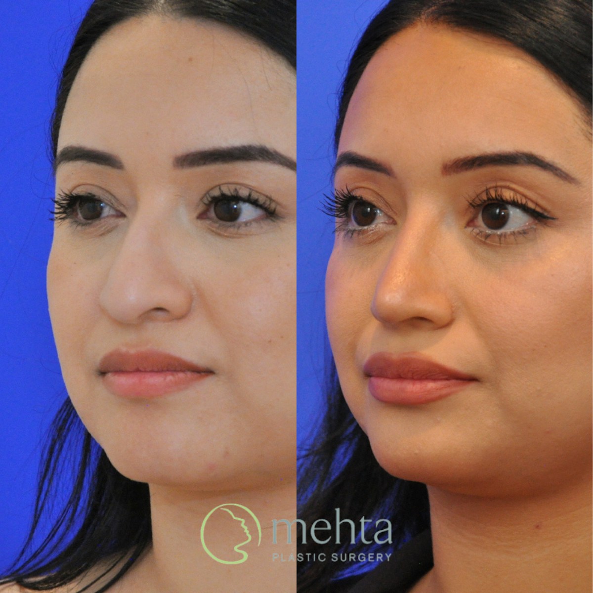 Rhinoplasty Before & After Gallery - Patient 697849 - Image 2