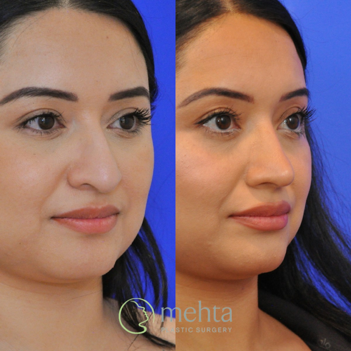 Rhinoplasty Before & After Gallery - Patient 697849 - Image 5