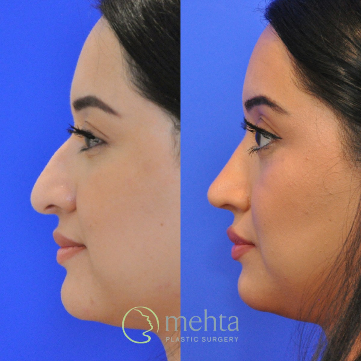 Rhinoplasty Before & After Gallery - Patient 697849 - Image 1