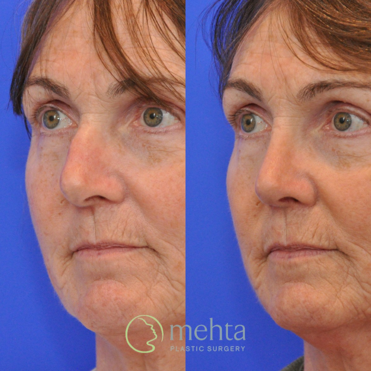 Rhinoplasty Before & After Gallery - Patient 374280 - Image 2