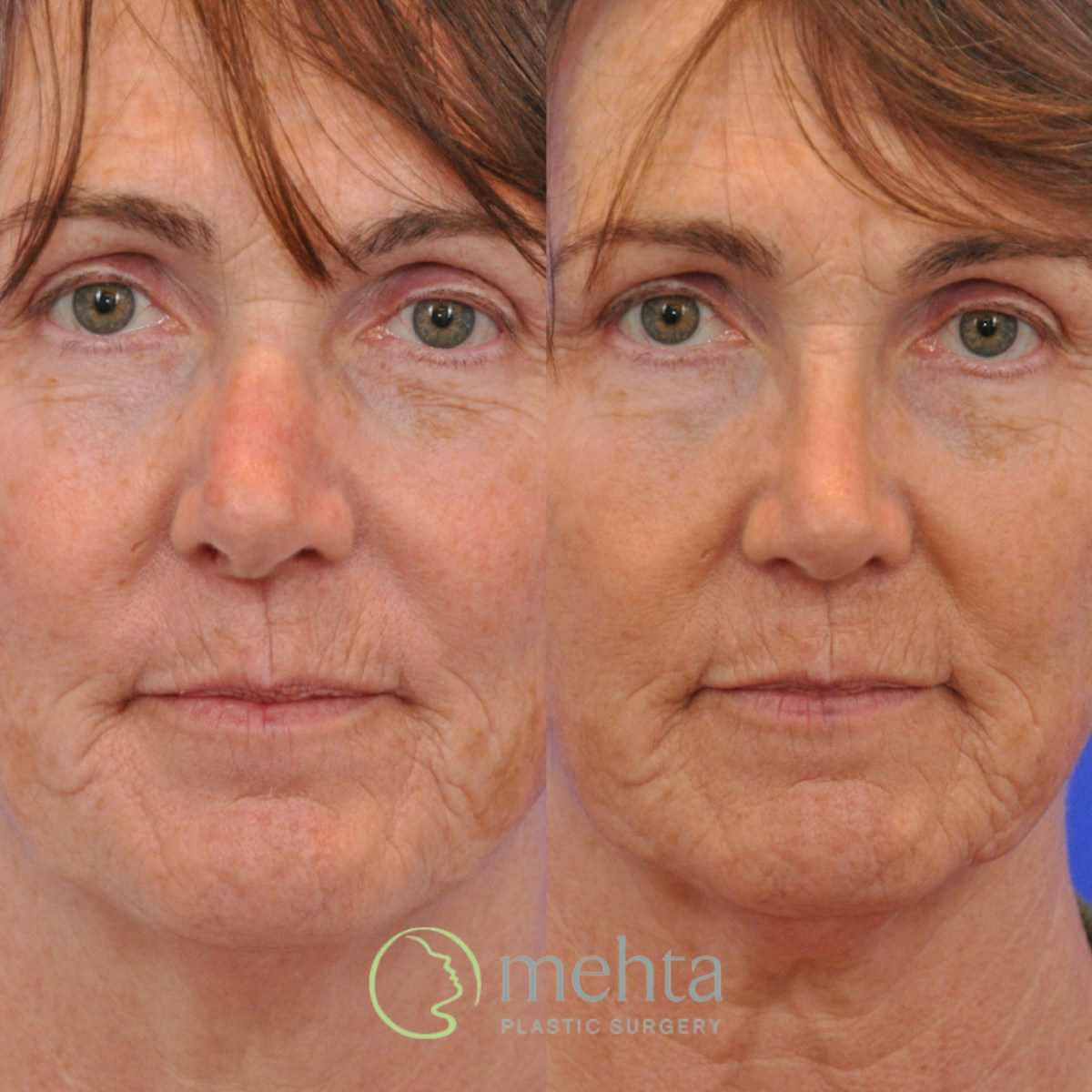 Rhinoplasty Before & After Gallery - Patient 374280 - Image 3