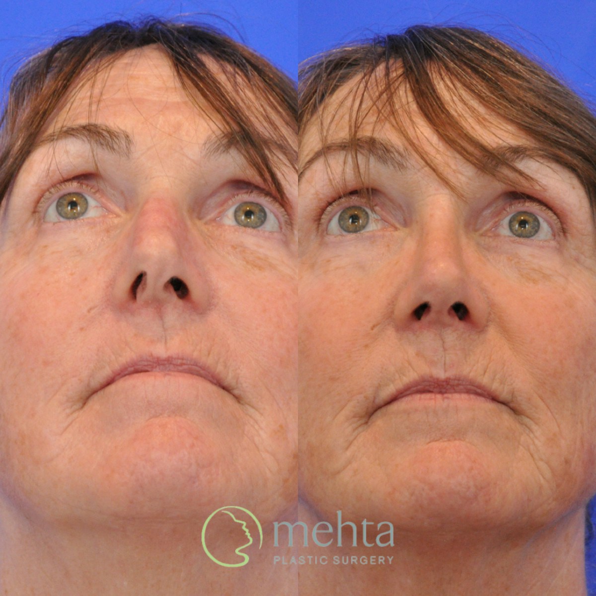 Rhinoplasty Before & After Gallery - Patient 374280 - Image 4