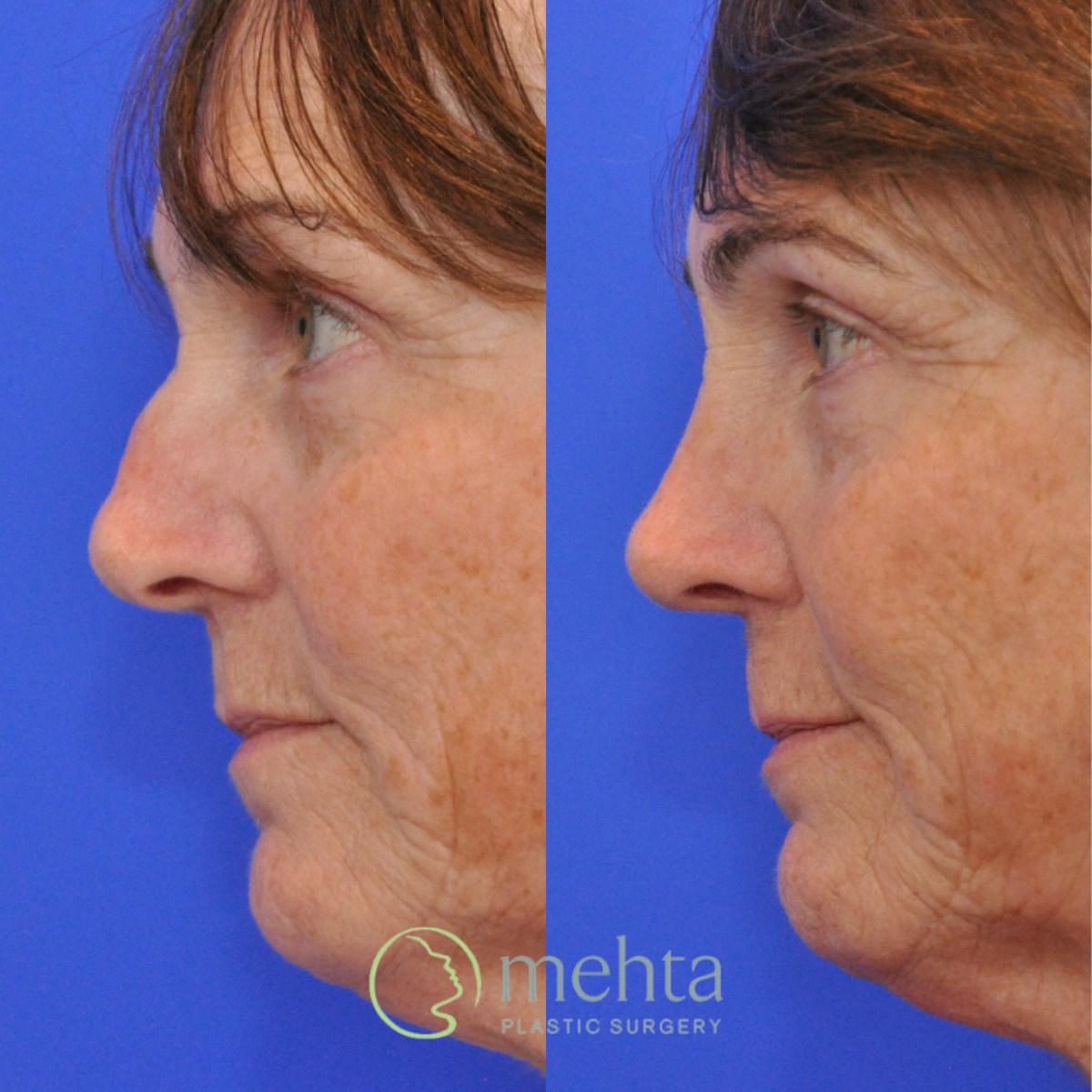 Rhinoplasty Before & After Gallery - Patient 374280 - Image 1