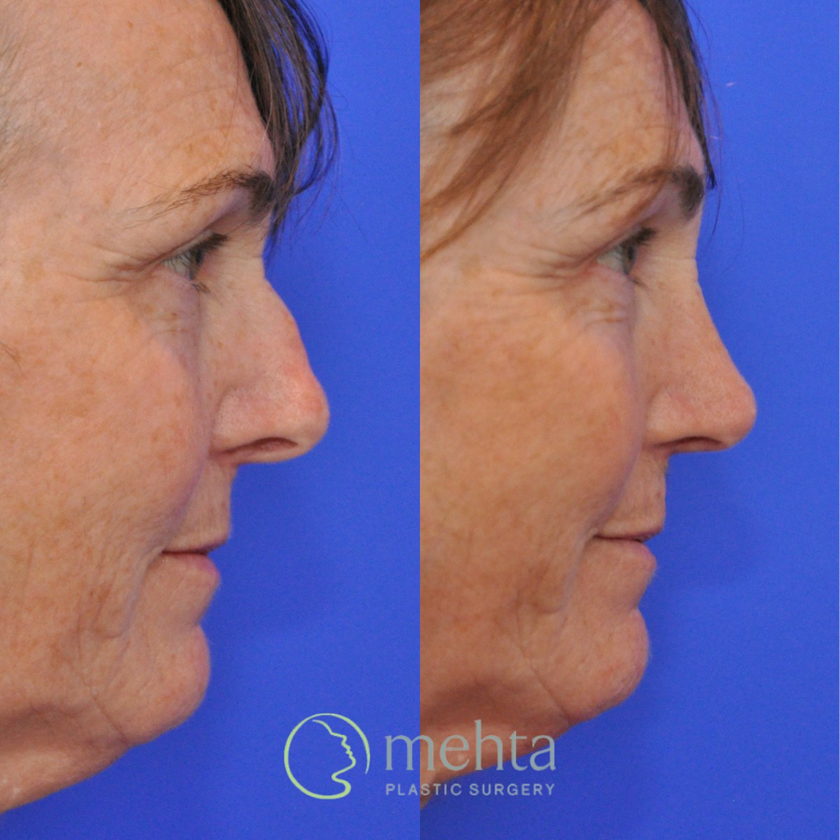 Rhinoplasty Before & After Gallery - Patient 374280 - Image 6