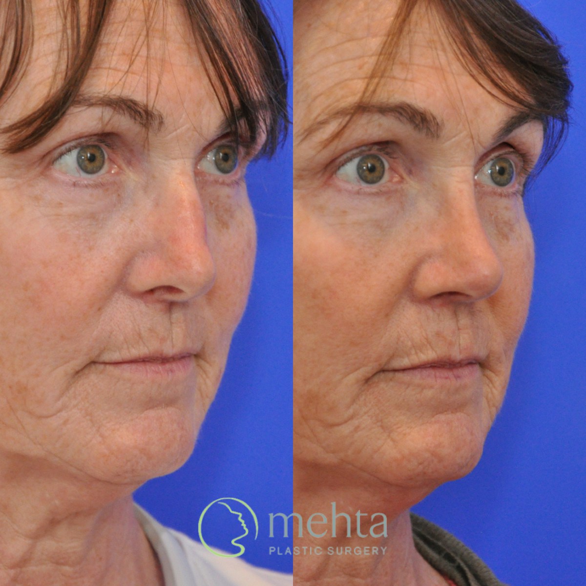Rhinoplasty Before & After Gallery - Patient 374280 - Image 5