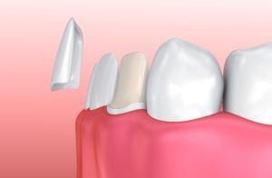 veneer being placed on a tooth