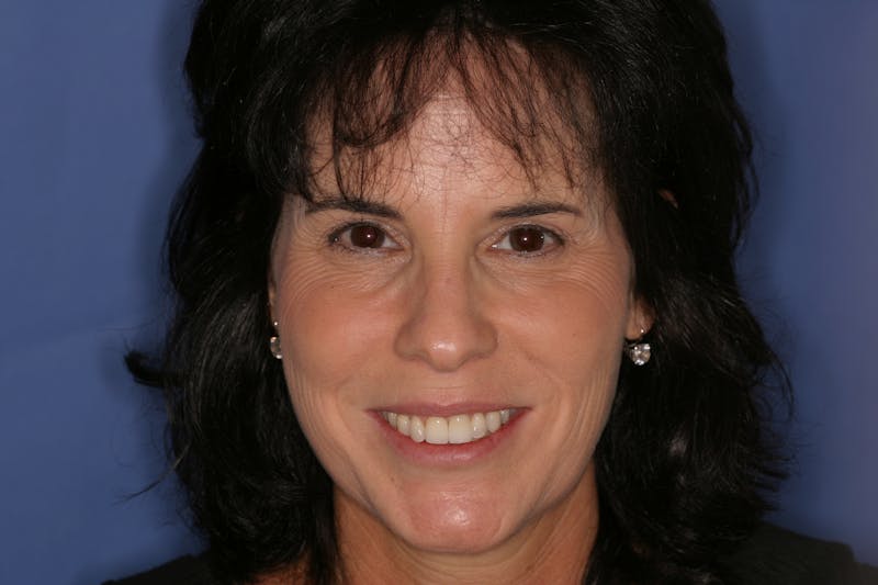 FloridasSmiles Smile Gallery patient