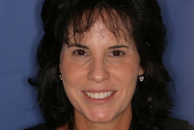 FloridasSmiles Smile (old all patients) Gallery patient