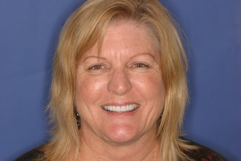 FloridasSmiles Smile Gallery patient