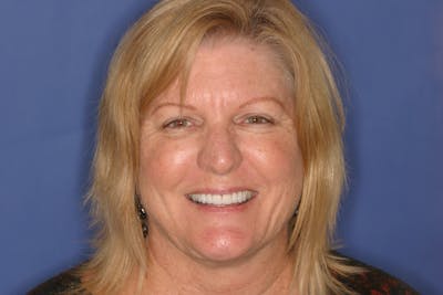 FloridasSmiles Porcelain Veneers Gallery patient