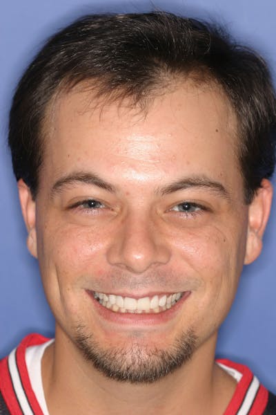 FloridasSmiles Porcelain Veneers Gallery patient