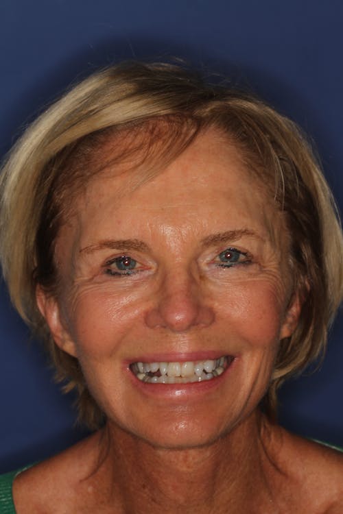 patient before Smile Makeover