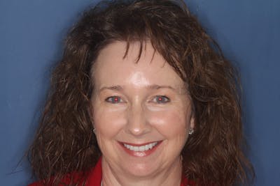 FloridasSmiles Porcelain Veneers Gallery patient