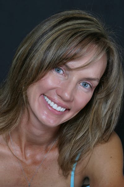 FloridasSmiles Porcelain Veneers Gallery patient