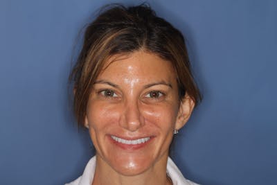 FloridasSmiles Porcelain Veneers Gallery patient