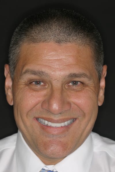 FloridasSmiles Porcelain Veneers Gallery patient