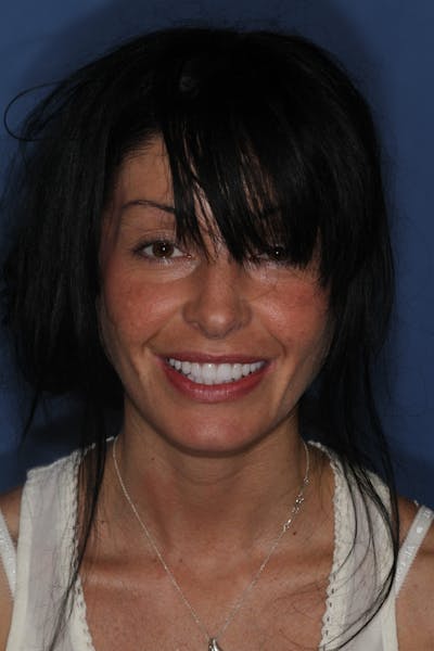 FloridasSmiles Porcelain Veneers Gallery patient