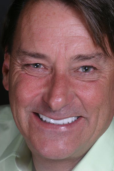 FloridasSmiles Porcelain Veneers Gallery patient